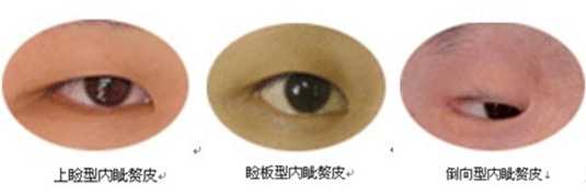 双眼皮割得不好看怎么补救,双眼皮割得不自然怎么办