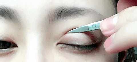 双眼皮割得不好看怎么补救,双眼皮割得不自然怎么办