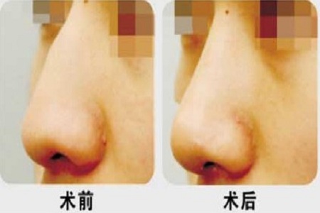 隆鼻手术做得再好也经不住瞎折腾,各种隆鼻手术方法究竟孰优孰劣