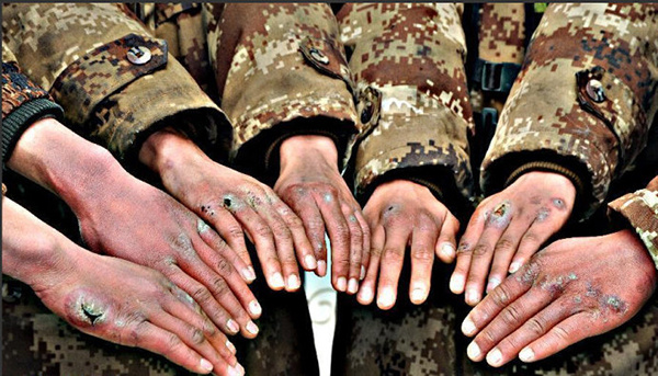 冬天生冻疮怎么办简单方法,冬天长冻疮是因为太冷了吗