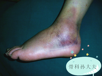 受伤后越揉越肿，疼痛加重，这样揉对了吗？