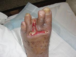 糖尿病一旦出现并发症怎么办,糖尿病最可怕的五种并发症的治疗