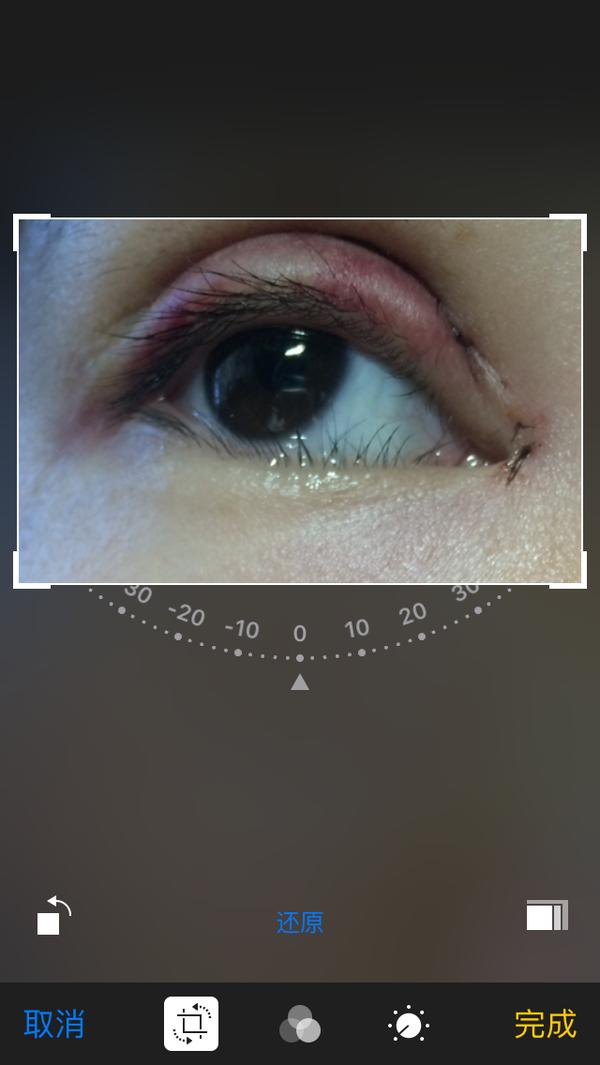 割完双眼皮后眼部吸脂,抽脂双眼皮做完眼睛有褶