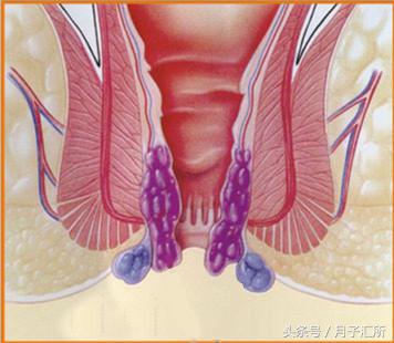 产后便秘把痔疮拉出来了,便秘后肛裂了怎么办