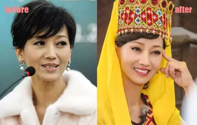 整牙=整容?看杨幂、刘涛、高圆圆为你亲身示范!