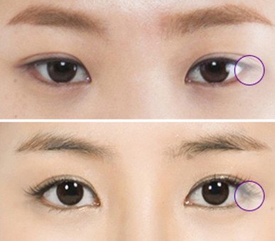 开眼角手术会减轻细纹吗,开眼角会让人显得更成熟吗