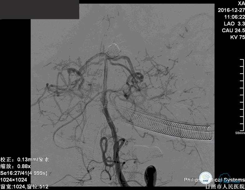 颈动脉瘤介入栓塞康复后可活多久,动脉瘤微创栓塞术全过程