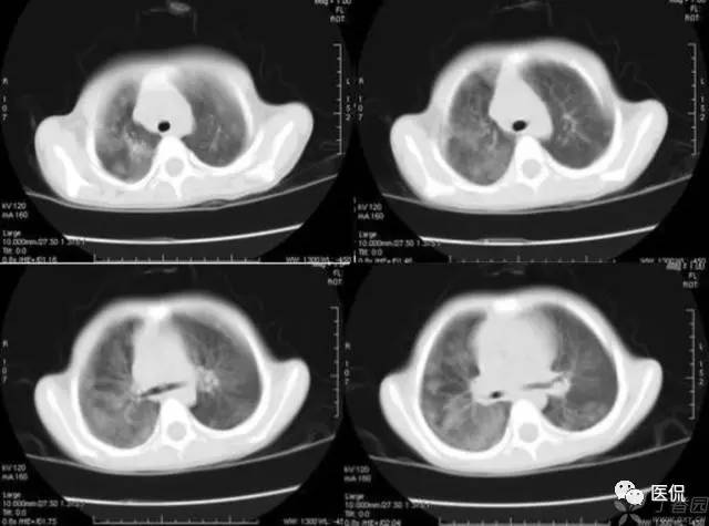影像学呼吸系统理论知识,呼吸系统疾病影像学常见征象