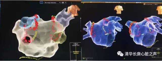 清华长庚心内科,邵逸夫多次消融治疗房颤新技术
