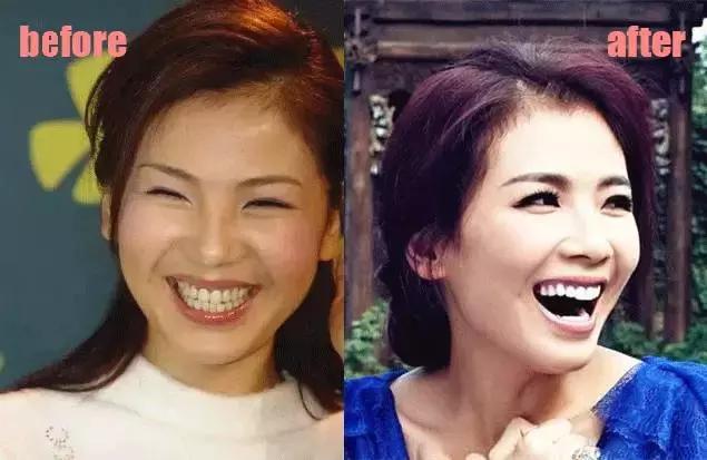 整牙=整容？看杨幂、刘涛、高圆圆为你亲身示范！