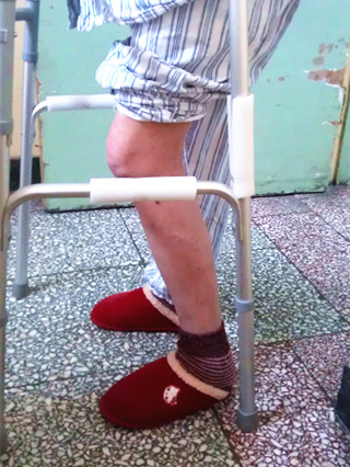 下肢受伤站立充血怎么办,长时间卧床下肢下垂发紫