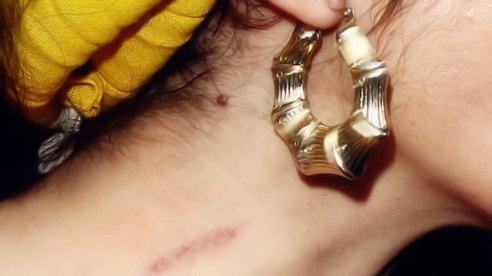 种完“草莓”不想虐狗？3min去除吻痕技能get√