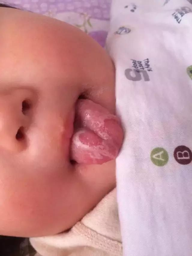 鹅鹅鹅鹅口疮，你需要知道这些