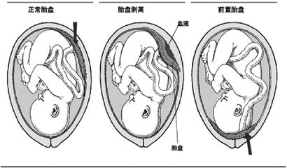 28周胎盘前置需要注意什么,怀孕30周前置胎盘注意事项