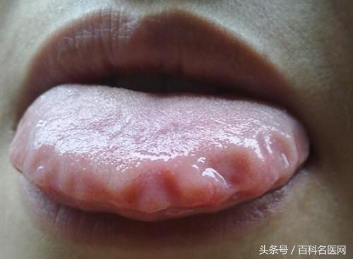 湿气困扰教你一招祛湿不再无效,湿气的三大克星