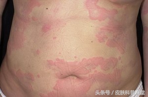 反复过敏要警惕,反复过敏但测过敏源不过敏