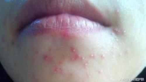 下巴爱长脓包痘痘怎么办,下巴周围反复长痘痘抹什么药膏