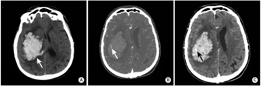 多图颅内出血影像学表现大全,头被撞后颅内出血有什么表现