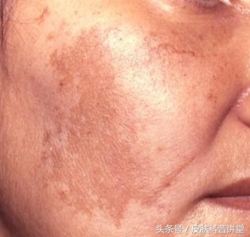 褐青色斑平时要注意什么,长褐斑是什么原因