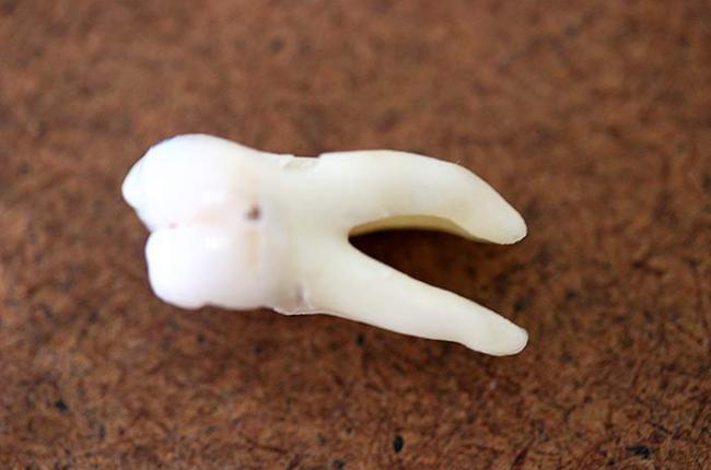 梦见自己掉牙齿是什么预兆,梦见自己掉牙齿是什么意思