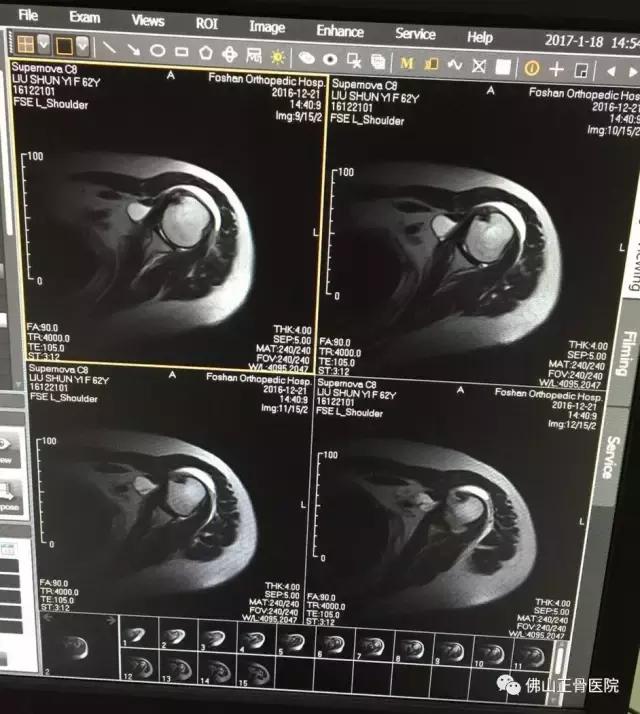 肌骨康复治疗技术讲解视频,康复学堂肩袖损伤康复训练
