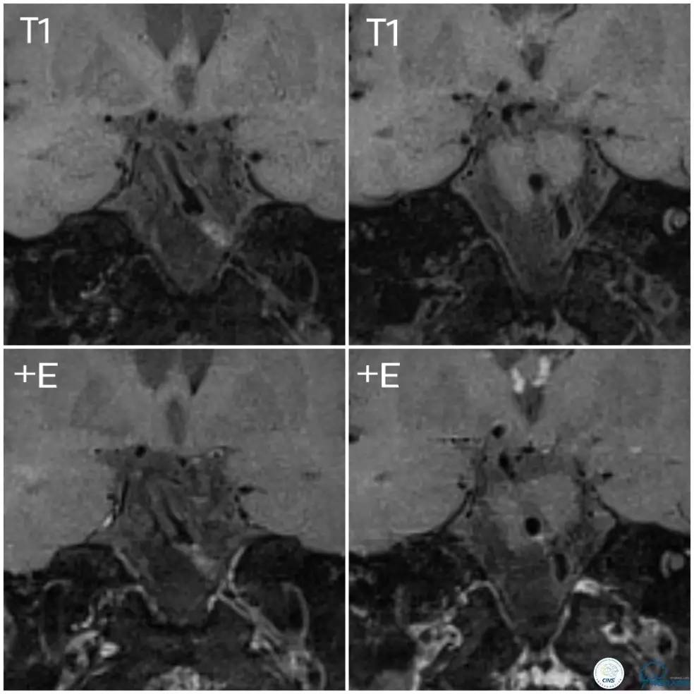 天坛周记|基底动脉狭窄合并动脉瘤血管内介入治疗一例