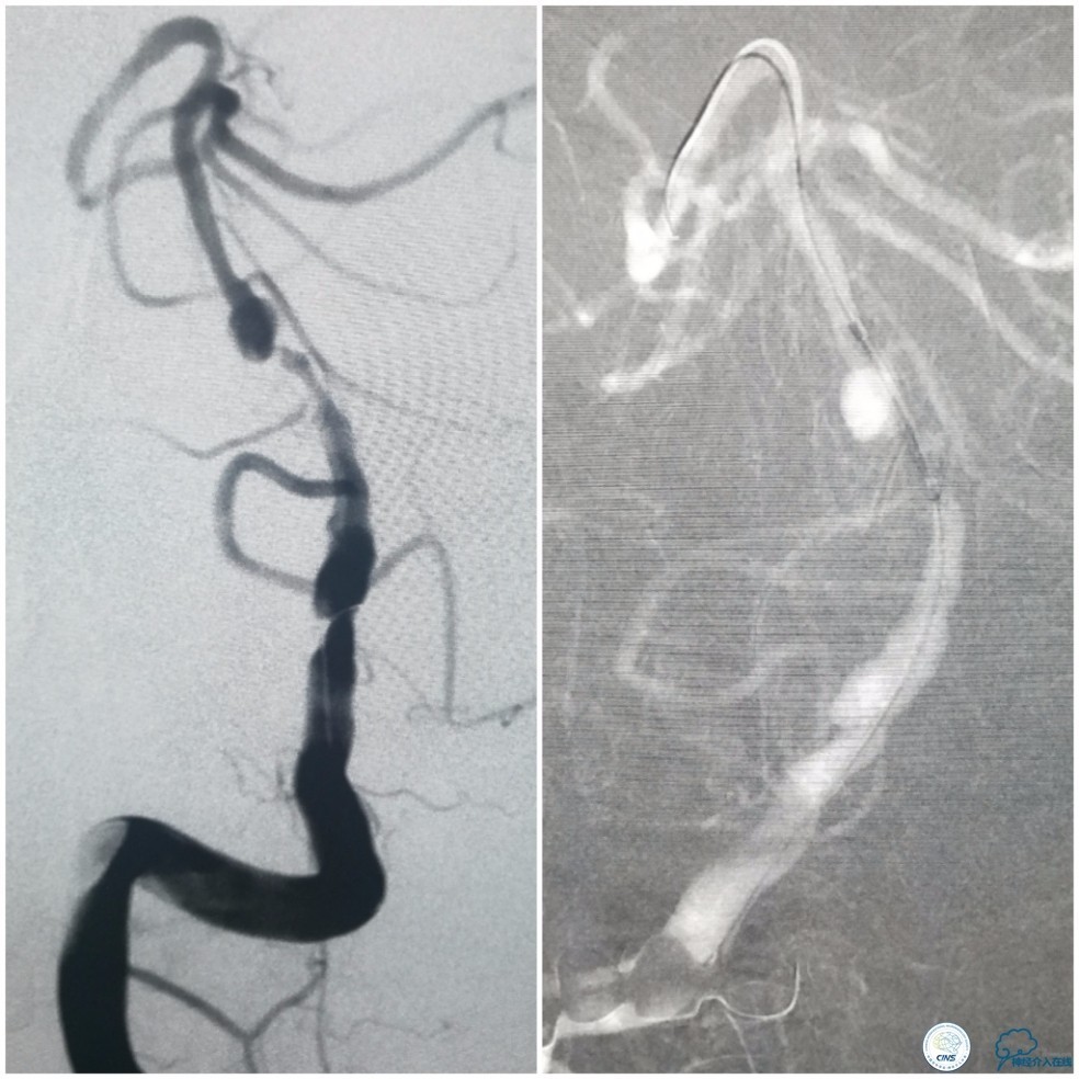 天坛周记|基底动脉狭窄合并动脉瘤血管内介入治疗一例