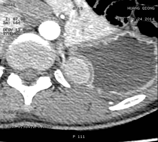当EUS遇到“假瘤子”(二)——都是“隔壁老王”惹的祸(毗邻外压)