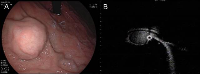 当EUS遇到“假瘤子”(二)——都是“隔壁老王”惹的祸(毗邻外压)