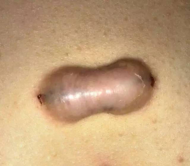 脚受伤有疤痕怎么处理,鼻子受伤疤痕怎么处理