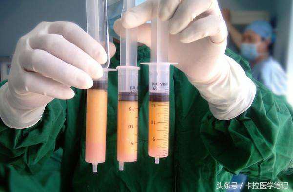 我想知道怎么进行吸脂减肥,想减肥不一定非要做手术吸脂