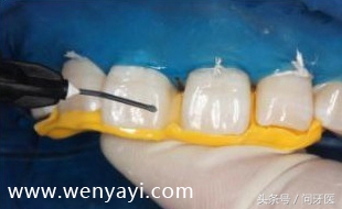 门牙有缝的女人有什么不好,门牙有缝怎么办如何补救