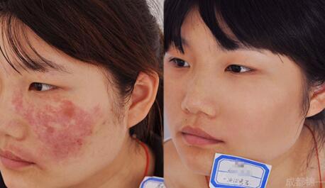 孩子有胎记如何避免孩子自卑,宝宝长胎记怎样避免心理健康