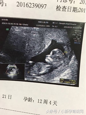 顺产日记小宝宝,顺产日记出生了男宝