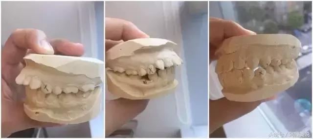 矫正前一定要做口扫吗,矫正前必须拍ct吗