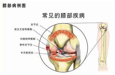 跑步时护膝的正确使用方法,跑步要重视护膝吗