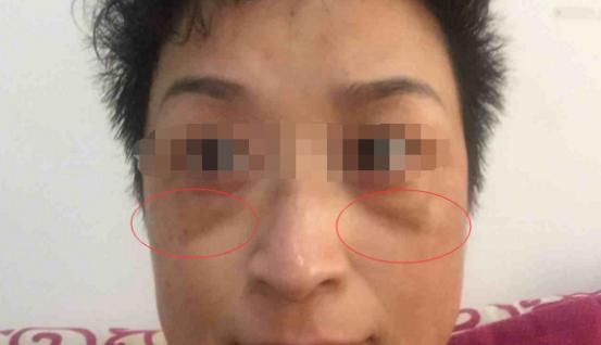 肝斑和褐青色斑的区别,褐青色斑和黄褐斑哪个严重