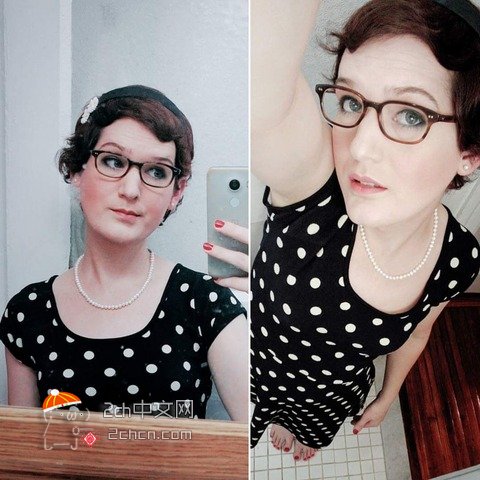 秃头大叔服用雌性激素,秃头男吃雌激素一年