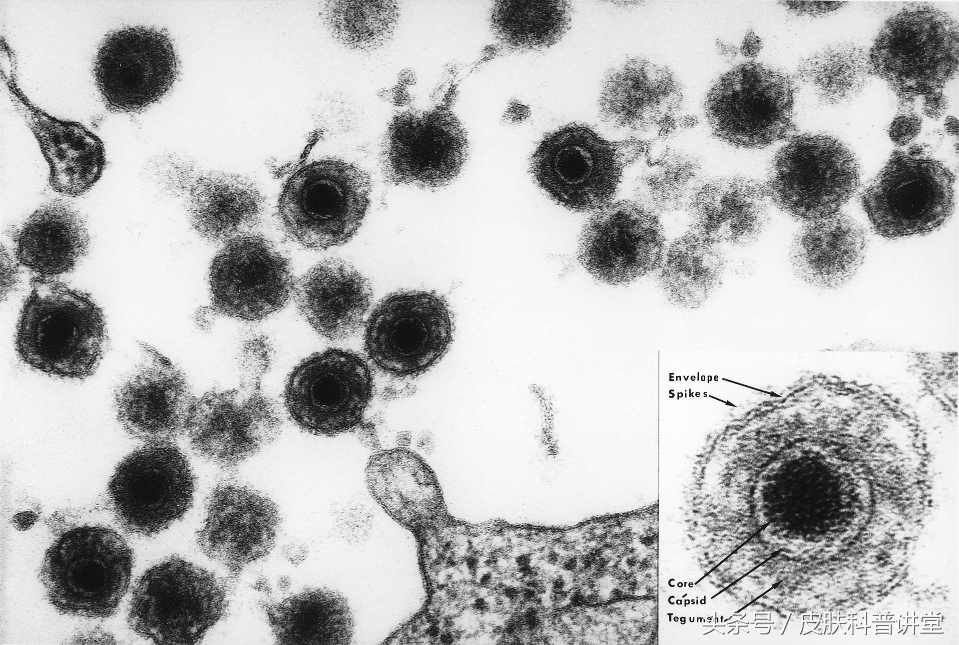 幼儿急疹的斑丘疹多久消失,幼儿急疹是否有痒的案例