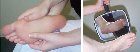 糖尿病足的预防重于治疗,糖尿病足病预防案例