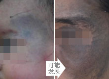 千奇百怪的胎记,各类胎记