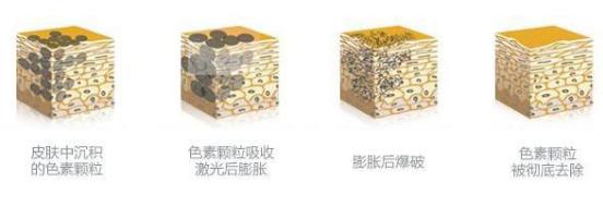 褐斑起因及调养,脸上出现褐斑是肝有问题吗