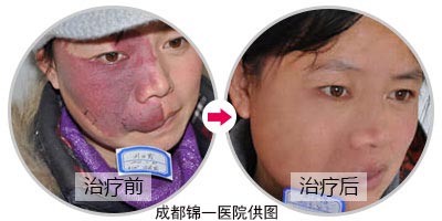 鲜红斑痣到底需不需要治疗？这个难题有答案了