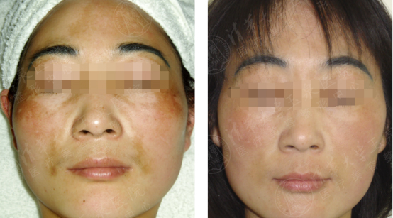 褐斑起因及调养,脸上出现褐斑是肝有问题吗