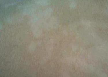 白癜风得病原因和治法,白癜风发病跟饮食有关吗