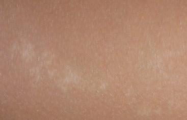 白癜风得病原因和治法,白癜风发病跟饮食有关吗