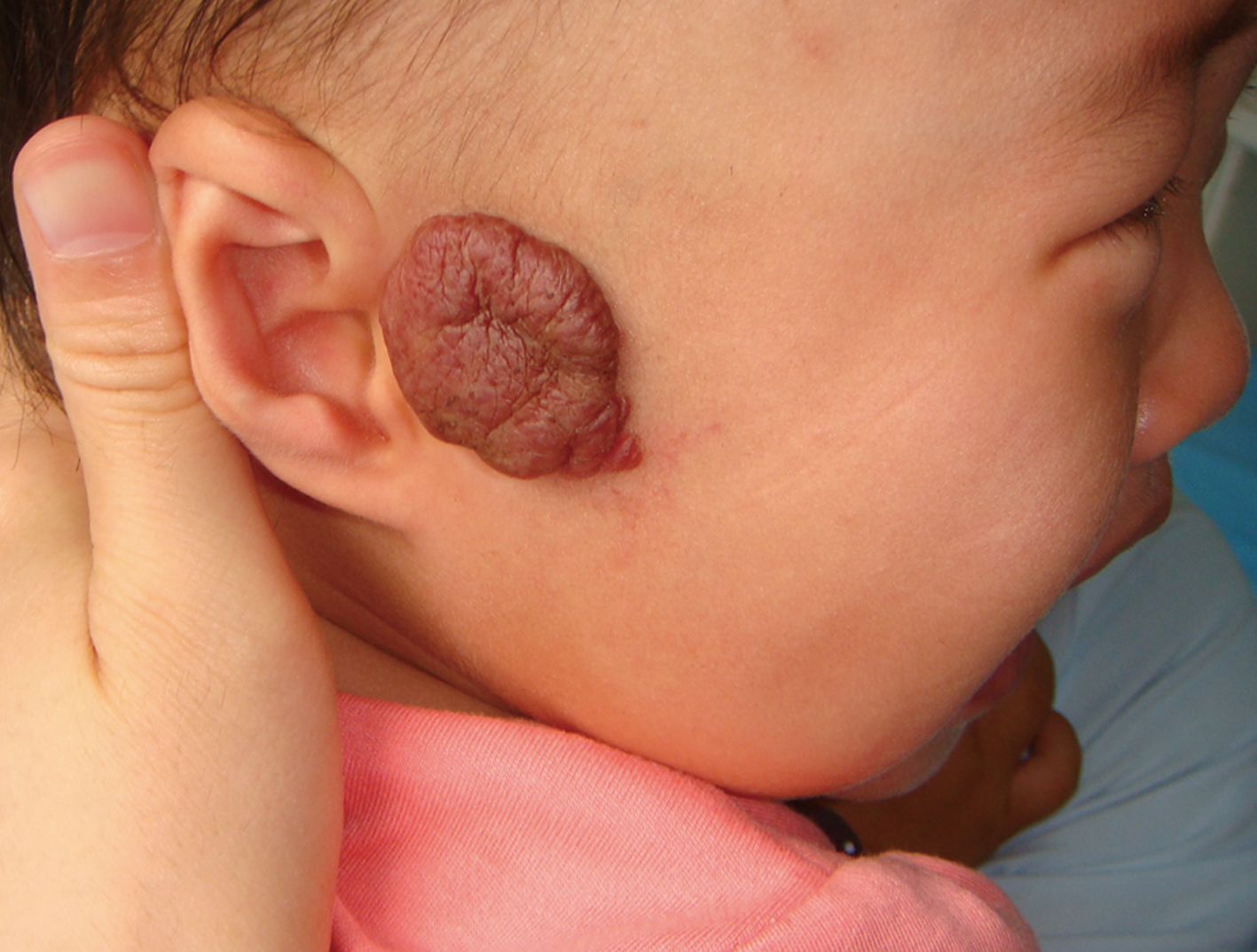 新生儿额头有块红的是啥,新生儿额头出现一片泛红