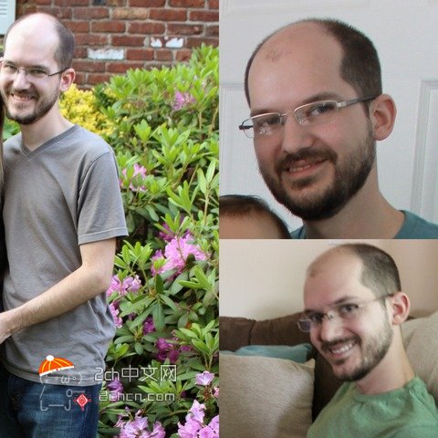 秃头大叔服用雌性激素,秃头男吃雌激素一年