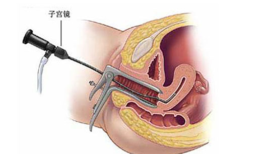 输卵管通水全过程视频真人版,输卵管通水是怎么做