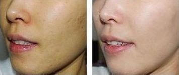 皮肤黄暗沉长痘如何改善学生党,面色暗黄爱出油是怎么回事